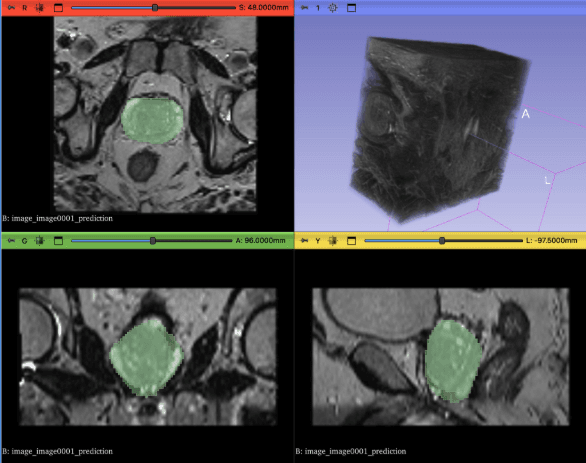 Prostate Cancer Detection thumbnail